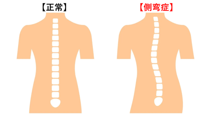 側彎症 ｜京都市西京区の桂東洋鍼灸整骨院